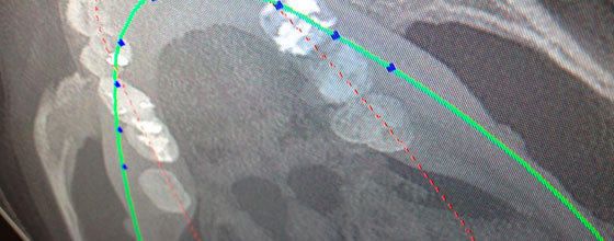 Digitale Volumentomographie zur besseren Planung von operativen Eingriffen im Kiefer