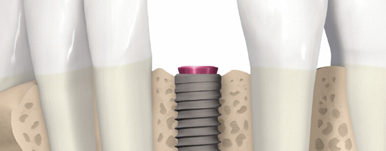 Implantate / Zahnimplantate / Implantologie in München | Grafik © Straumann Holding AG